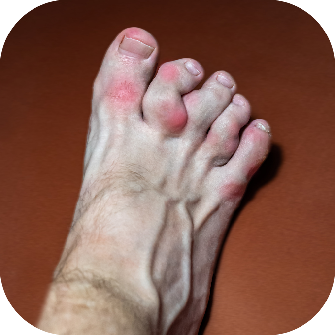 bị gout