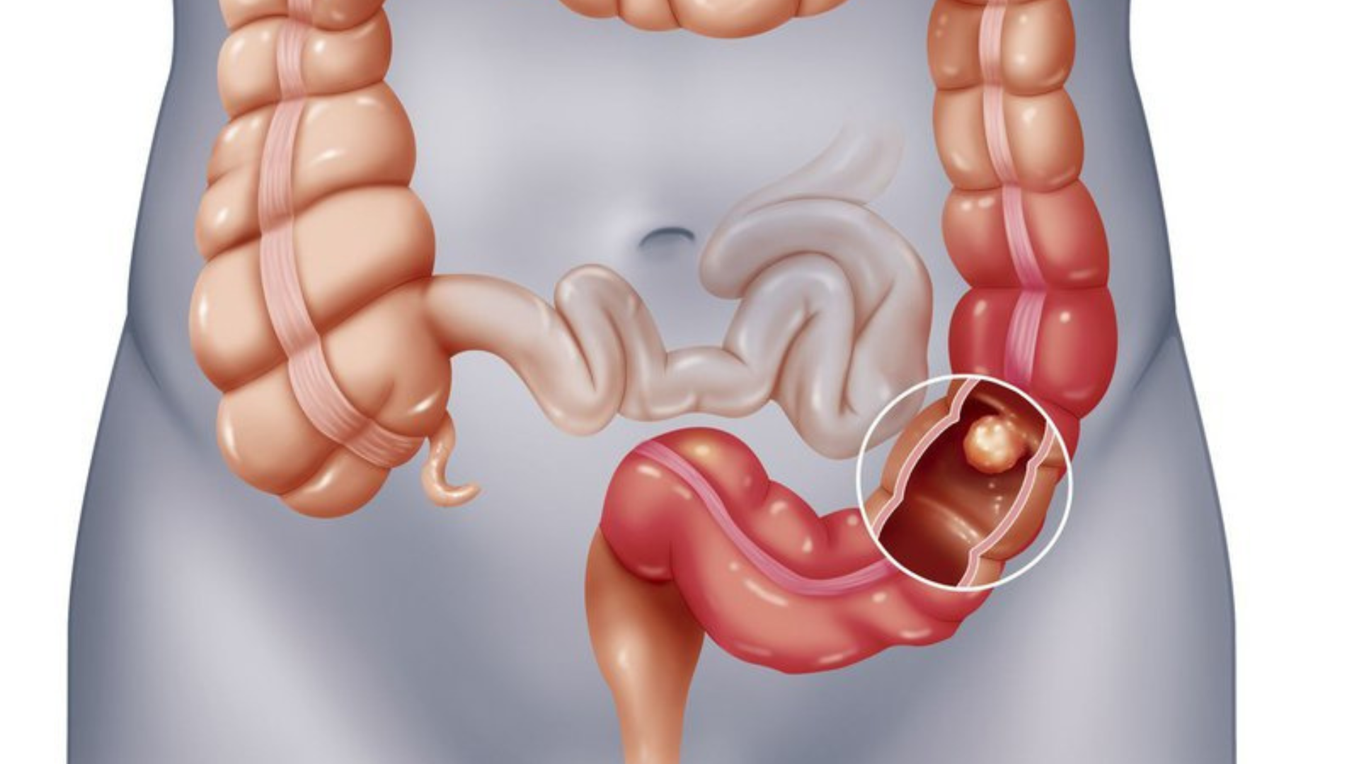 Đi ngoài có váng dầu nguy hiểm không?